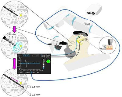 Prospective Validation of Facial Nerve Monitoring to Prevent Nerve Damage During Robotic Drilling